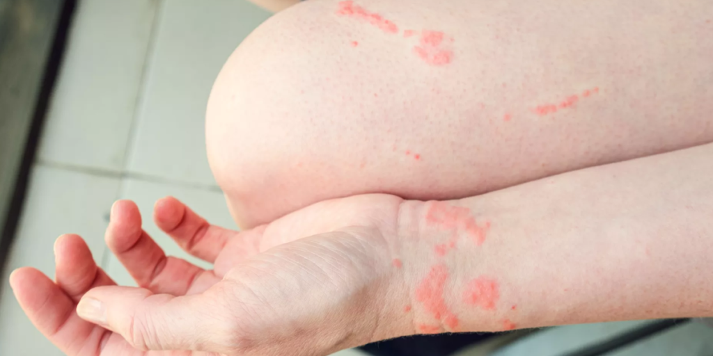 Complications – Can Cat Scratch Fever Get Worse?